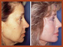 face and neck implant img 1