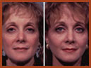 face and neck implant img 2