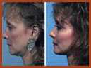 faceliftandmidfaceimplant img 3