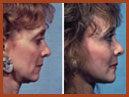 faceliftandmidfaceimplant img 4