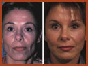 faceliftandmidfaceimplant img 5
