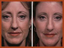 faceliftandmidfaceimplant 6 image