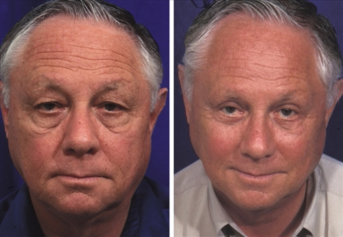 midfacelift 1 image