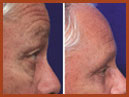 mid face implants 3