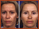 mid face implants 4