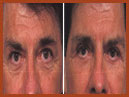 midfacelift image 5